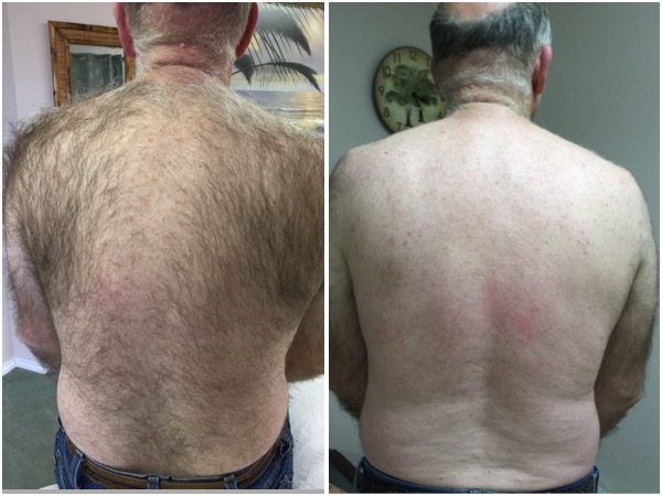 Back sugaring before and after