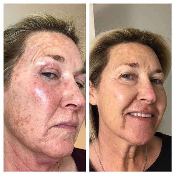 Elaine Brennan Get Glowing Micro-peel Near Hurst, Euless, And Bedford ...